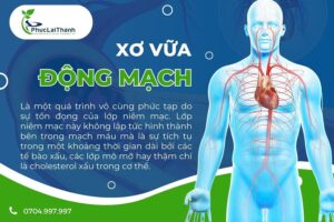 Xơ vừa động mạch