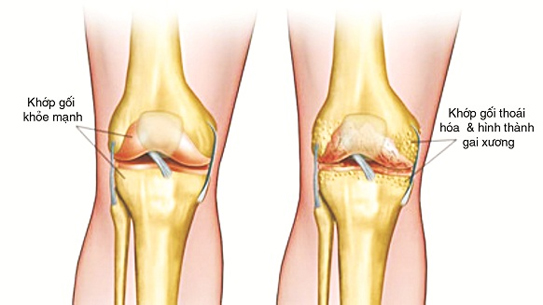 bệnh thoái hóa khớp gối