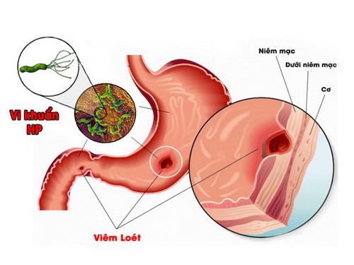 Viêm teo niêm mạc dạ dày