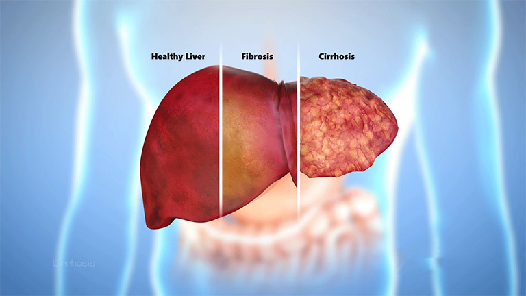 Bệnh Xơ Gan Có Chữa Được Không