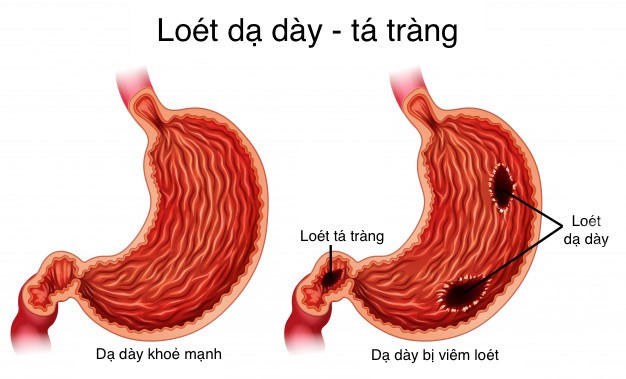 triệu chứng viêm loét dạ dày tá tràng