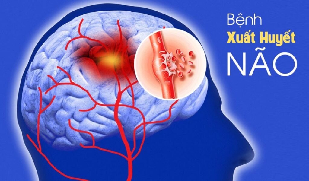 Nguyên nhân gây xuất huyết não