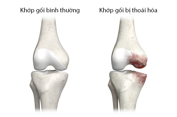 bệnh thoái hóa khớp gối