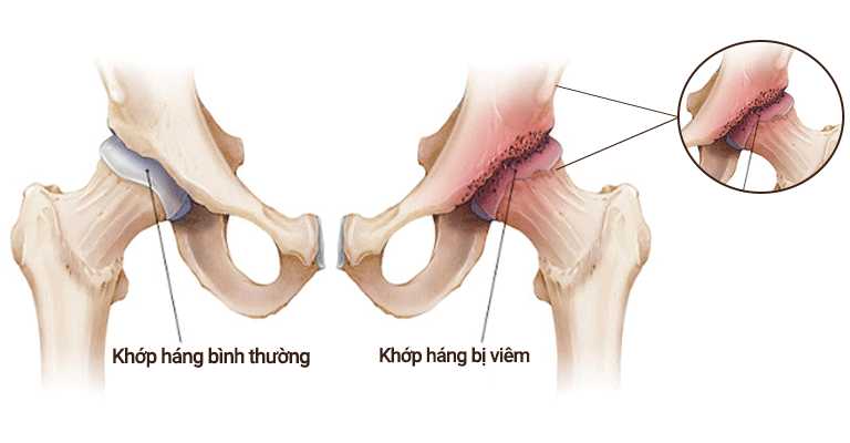 viêm khớp háng ở người lớn