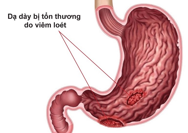 triệu chứng viêm loét dạ dày tá tràng