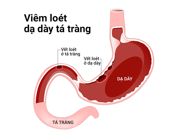 dấu hiệu viêm loét dạ dày