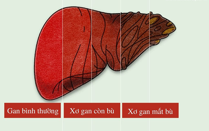 dấu hiệu bị xơ gan