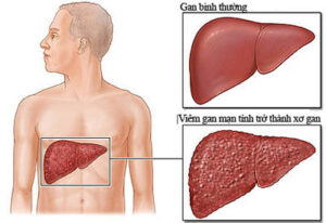 dấu hiệu bị xơ gan