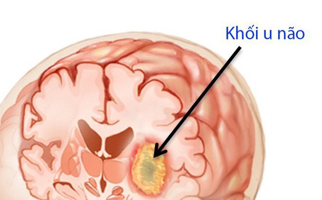 ung thư não giai đoạn cuối