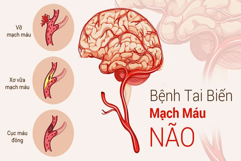 Dấu Hiệu Tai Biến Mạch Máu Não