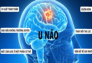 ung thư não giai đoạn đầu