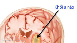 ung thư não giai đoạn đầu. 