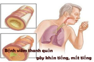 bài thuốc dân gian chữa viêm thanh quản