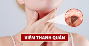 bài thuốc dân gian chữa viêm thanh quản