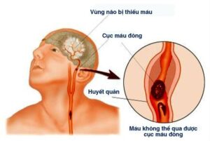 bệnh án nhồi máu não