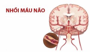 Nguyên nhân dẫn đến nhồi máu não