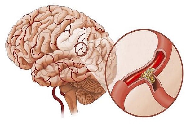 Nguyên Nhân Tai Biến Mạch Máu Não