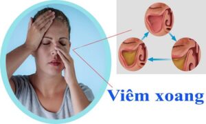 cách chữa trị viêm xoang tận gốc