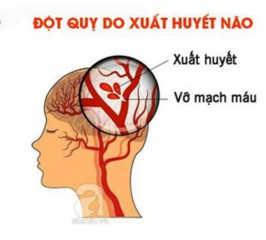 cách sơ cứu đột quỵ