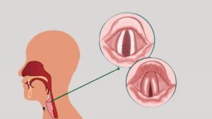 cách trị viêm thanh quản ở nhà 