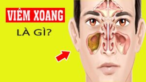 dấu hiệu của viêm xoang