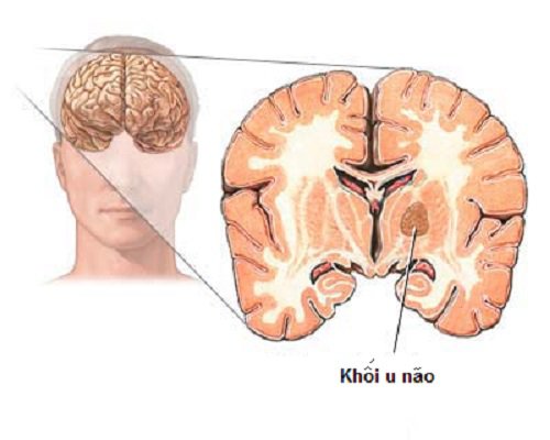 Dấu hiệu u não ác tính