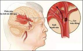 Hiện tượng đột quỵ 