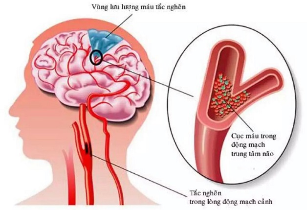 Phân biệt nhồi máu não và xuất huyết não