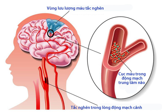 Dấu Hiệu Tai Biến Mạch Máu Não