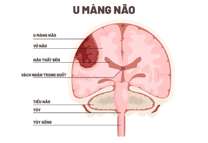 U màng não có nguy hiểm không