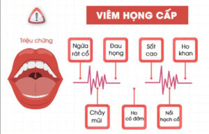 Viêm họng cấp là gì 