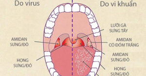 Viêm họng cấp là gì 