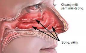 viêm mũi dị ứng thời tiết