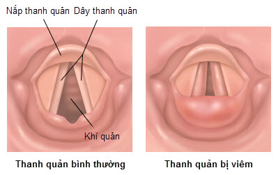 viêm thanh quản cấp ở trẻ em