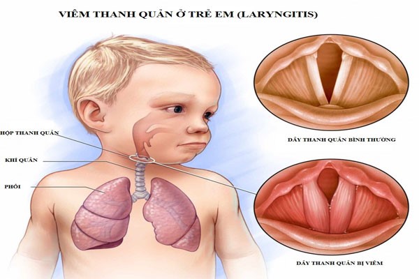 viêm thanh quản cấp ở trẻ em